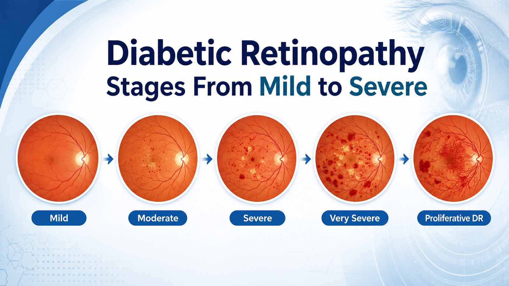 diabetic retinopathy stages