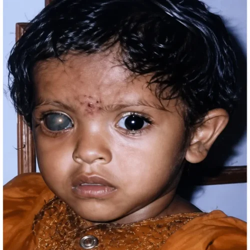 Girl Drashti netralaya