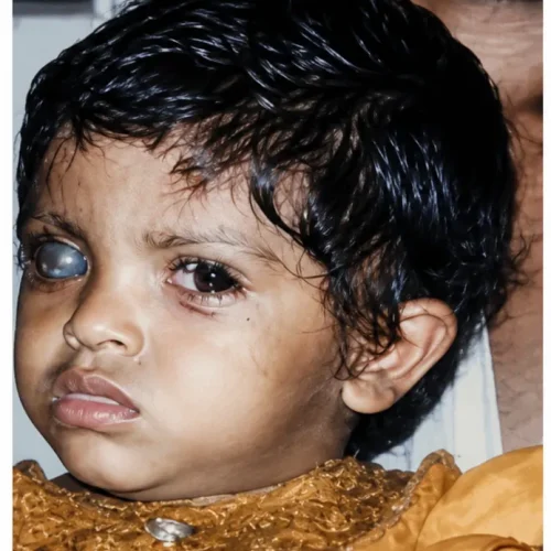 Girl Drashti netralaya